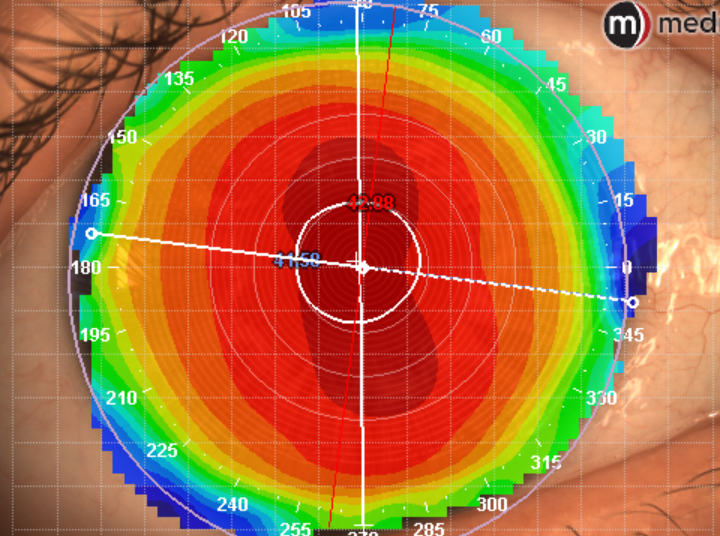 fitting ICD Flexfit with medmont - generic topography capture with meridia